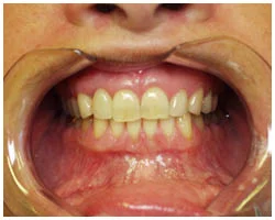After Implants