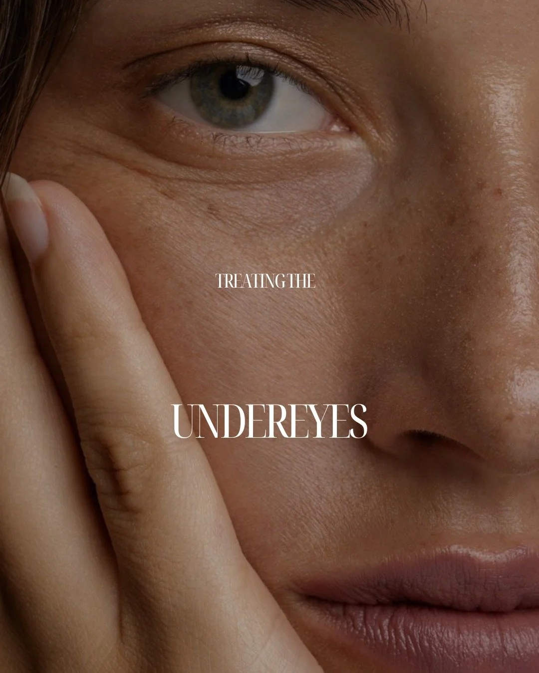 The under eye area requires a thoughtful and anatomically considered approach.
ㅤ
This region is influenced by multiple layers including skin thickness, muscle movement, fat pad distribution and bone structure. During consultation, we assess the area 