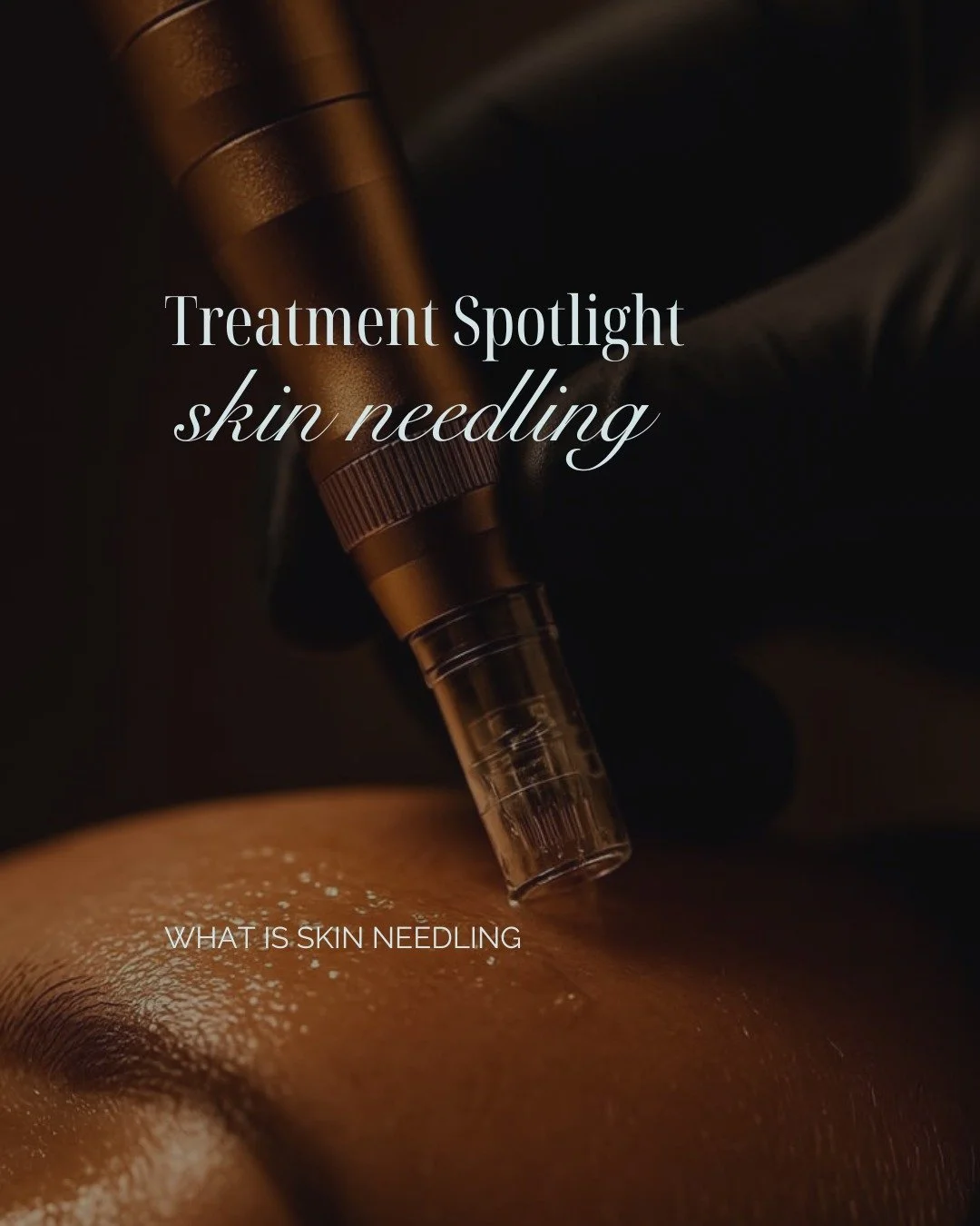 Skin needling is one of the more well-researched skin procedures available in aesthetic medicine, and it is one that Nurse Jess at Dr. Glow has a strong clinical background in.
ㅤ
The mechanism works through the skin's own wound healing cascade. Fine 