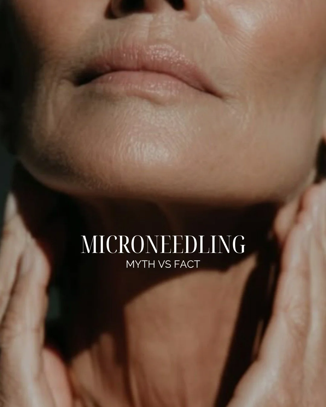 A few assumptions about skin needling worth clearing up before your next consultation, not after.
ㅤ
Book a consultation via the link in bio.
ㅤ
Dr. Sally Staves, GP and Cosmetic Medicine Practitioner, MBChB, RACGP, AHPRA MED0001758503 Jessica Chinchil