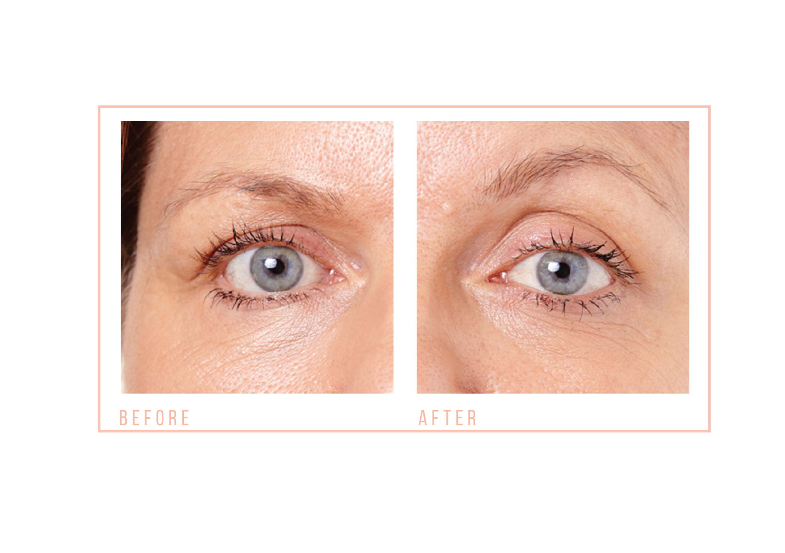 caci eye revive