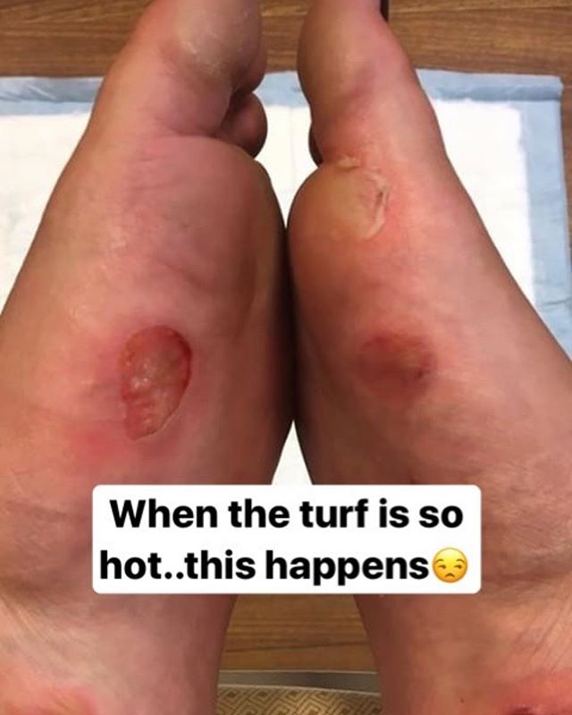 Turf reeks havoc on people&rsquo;s feet. Blusol heat shield stops the heat transfer from the turf to your foot so your feet don&rsquo;t look like this! #shieldup