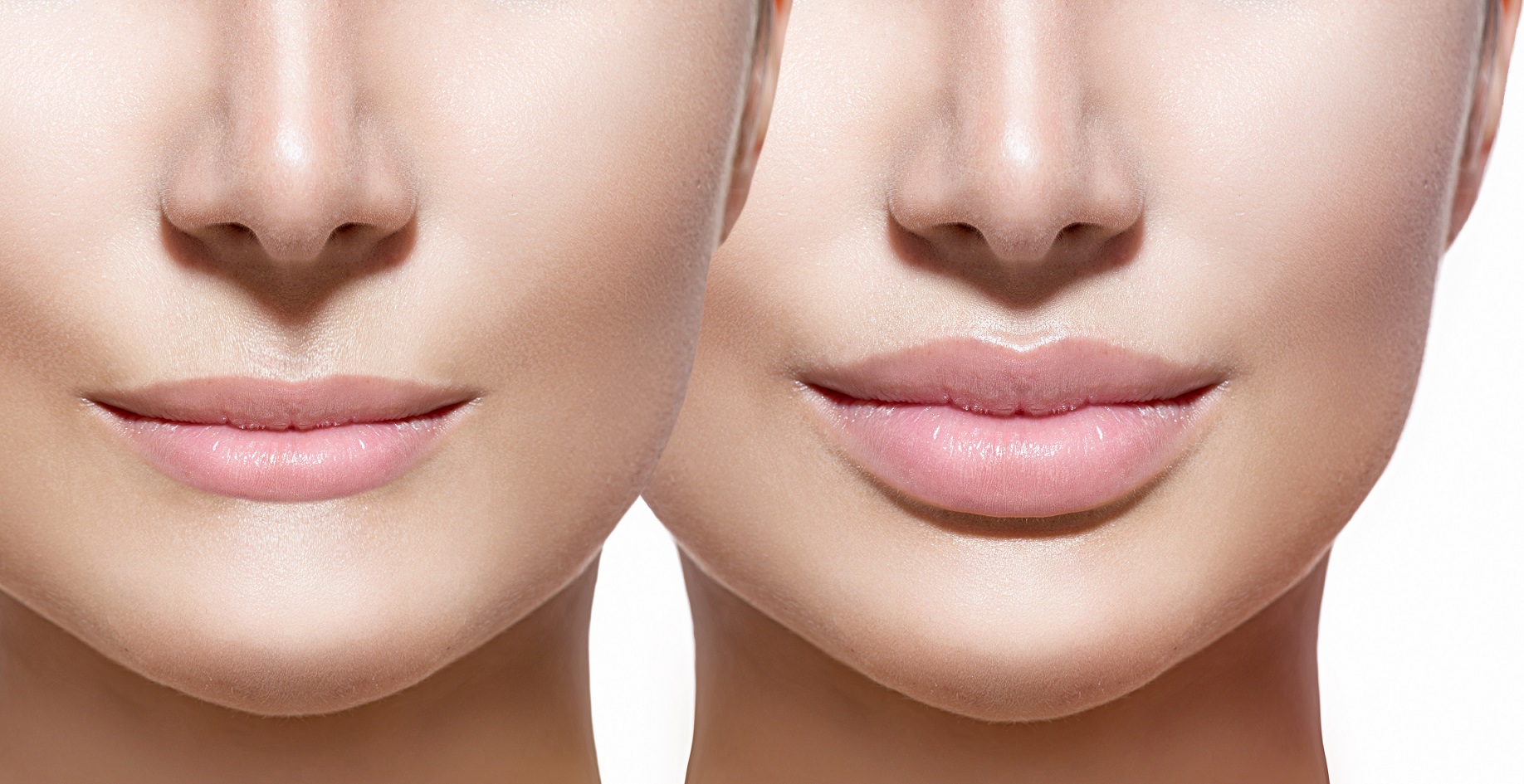 Thin Lips  Flawless Med Spa
