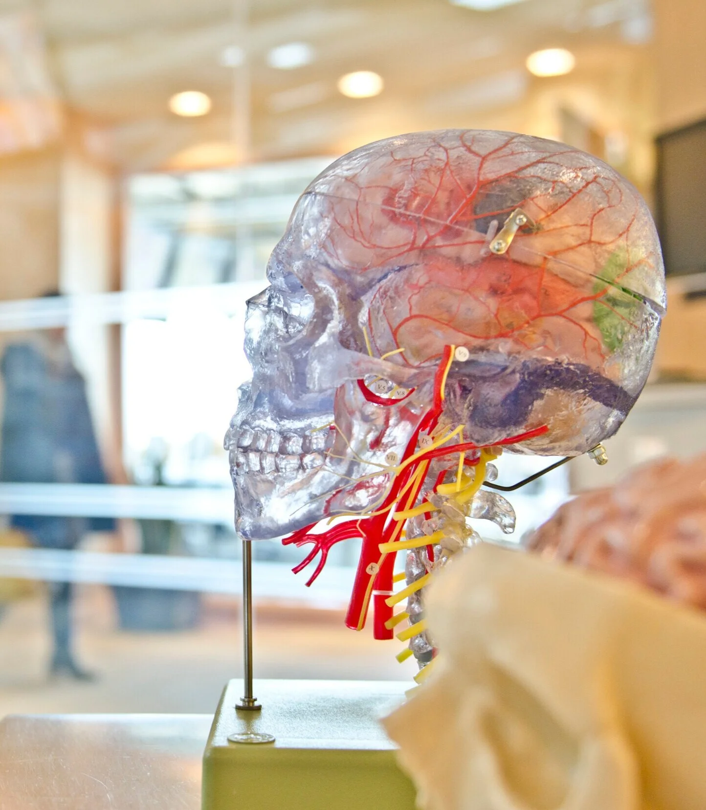 Neuroradiology Case "Vertebral Artery Dissection"