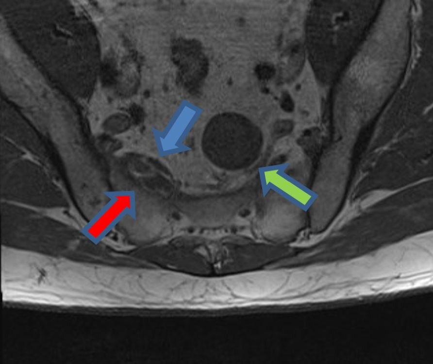 Why do I need a neuroradiologist to interpret my spine MRI images? What is Piriformis Syndrome?