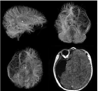 Diffusion Tensor Imaging (DTI) in mild Traumatic Brain Injury (mTBI)