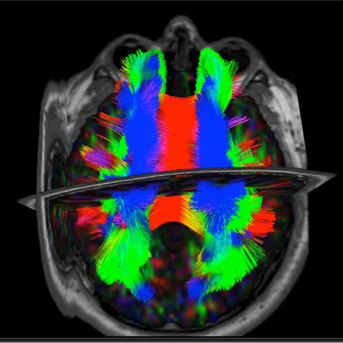 Diffusion Tensor Imaging in Traumatic Brain Injury, Neuropsychology