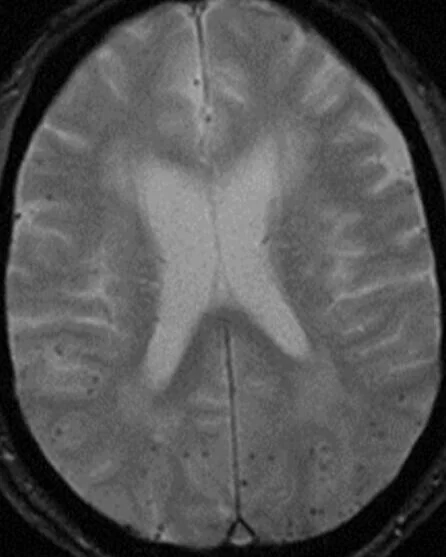 Why do I need a neuroradiologist to interpret my brain MRI?  What is Inflammatory Cerebral Amyloid Angiopathy?