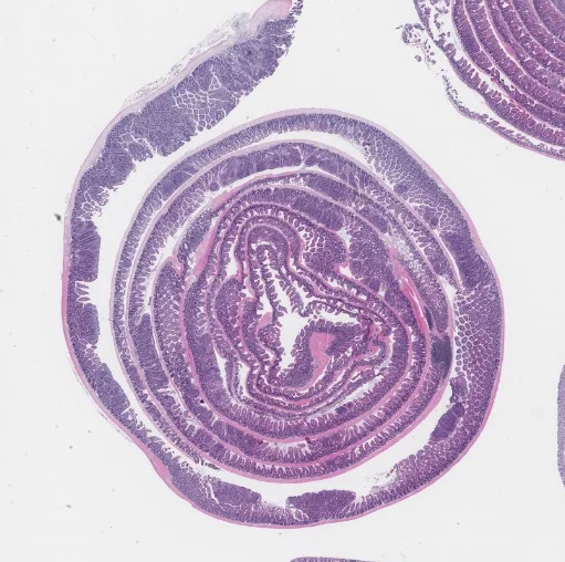 intestine tumors_edited 2.jpg