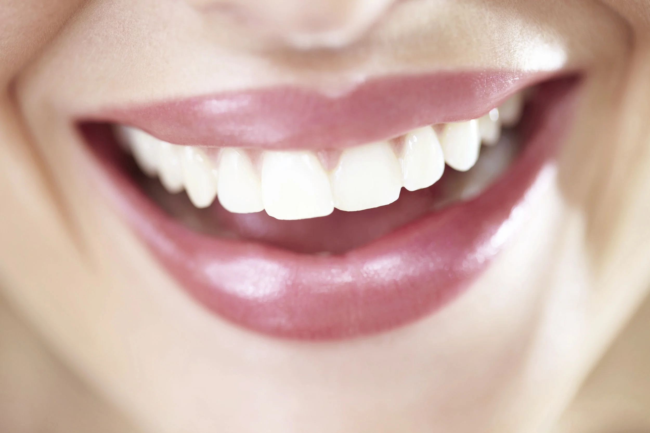dental-veneers.jpg
