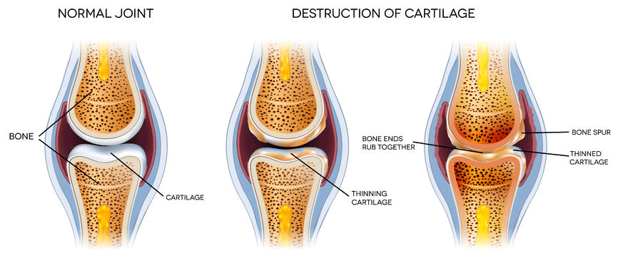 osteoarthritis_description.png
