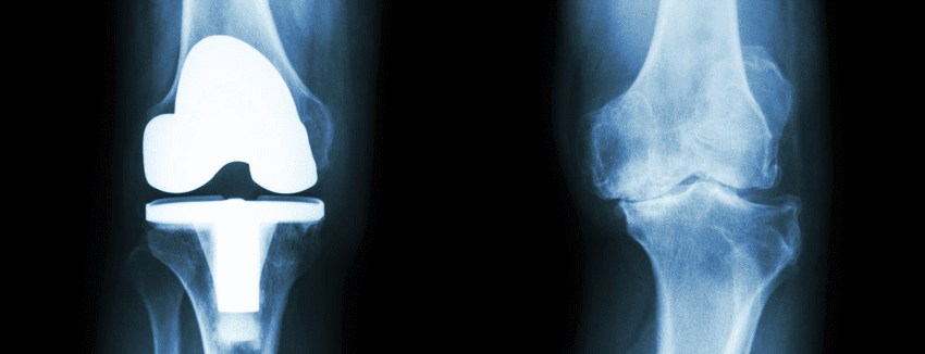 osteoarthritis_image.png
