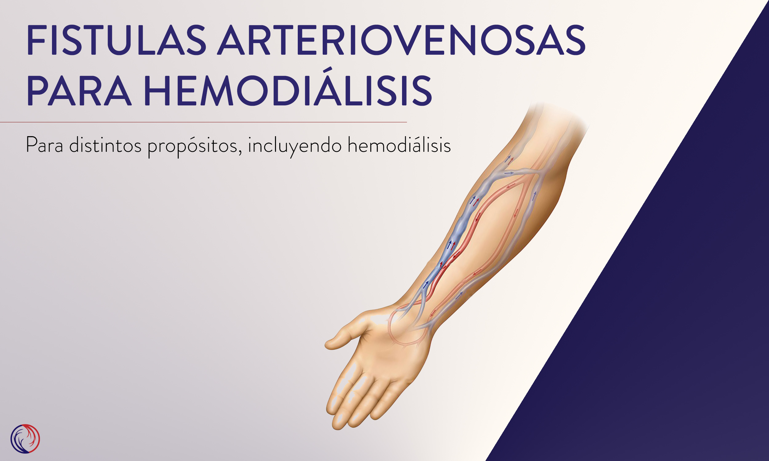 Fistulas arteriovenosas para hemodiálisis