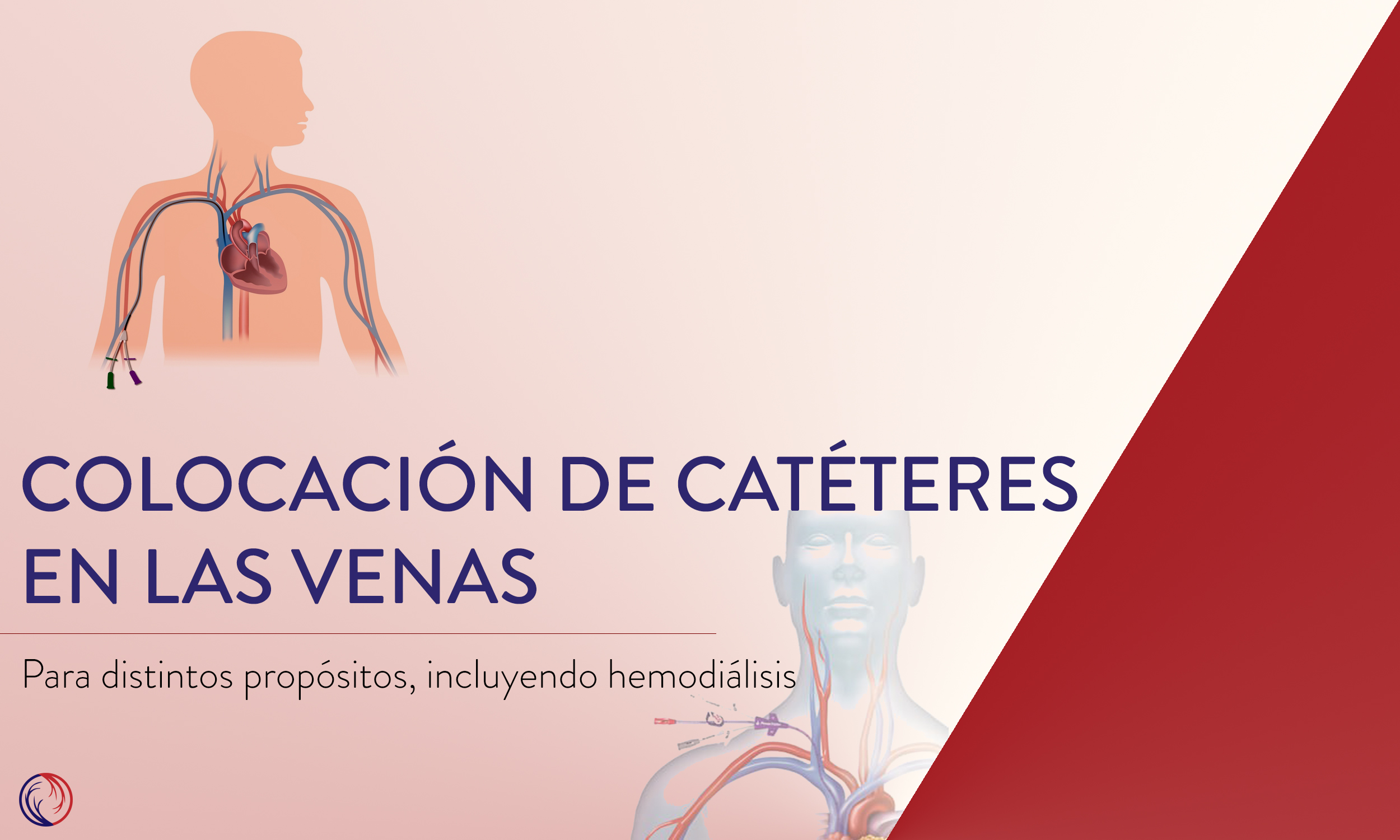 Colocación de catéteres en las venas