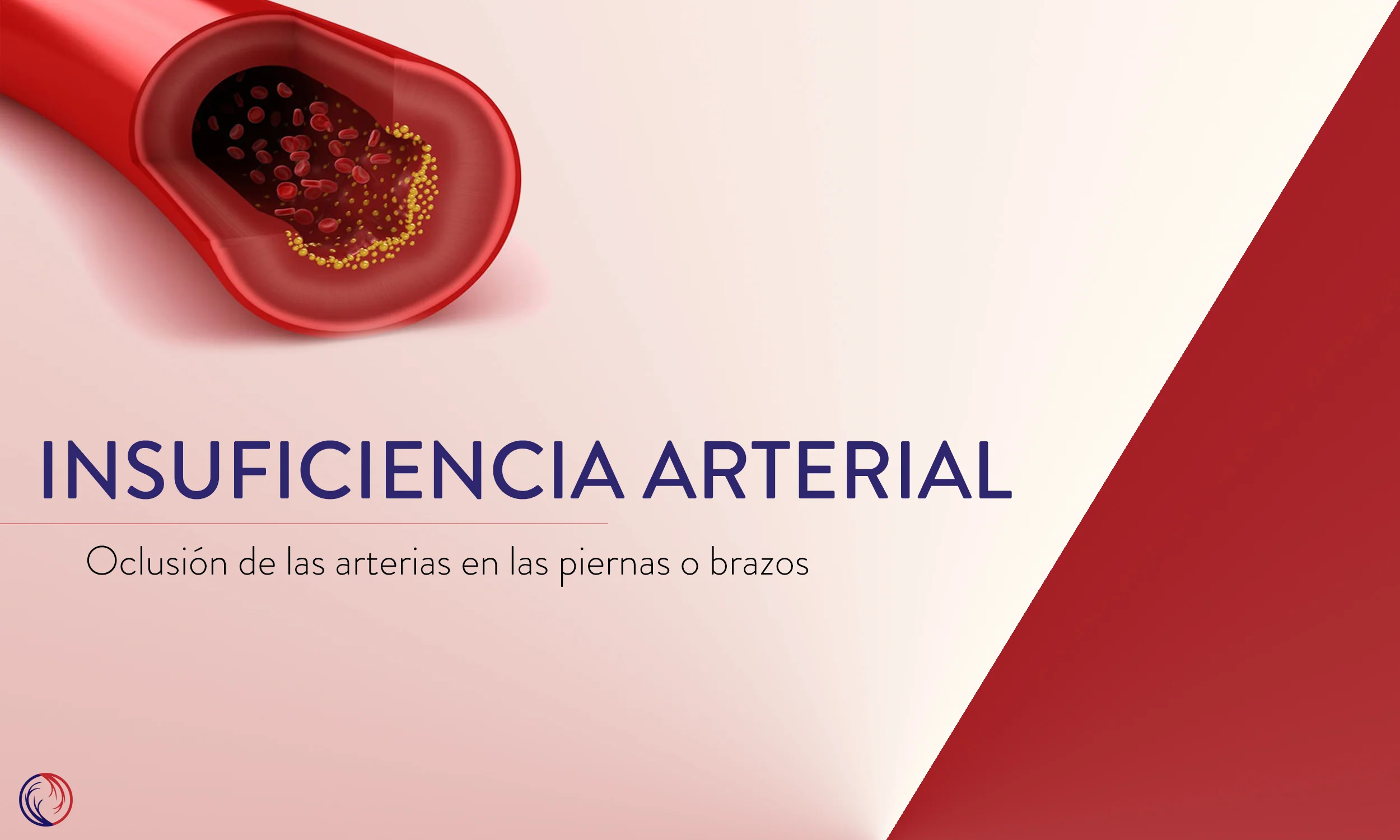 Insuficiencia arterial