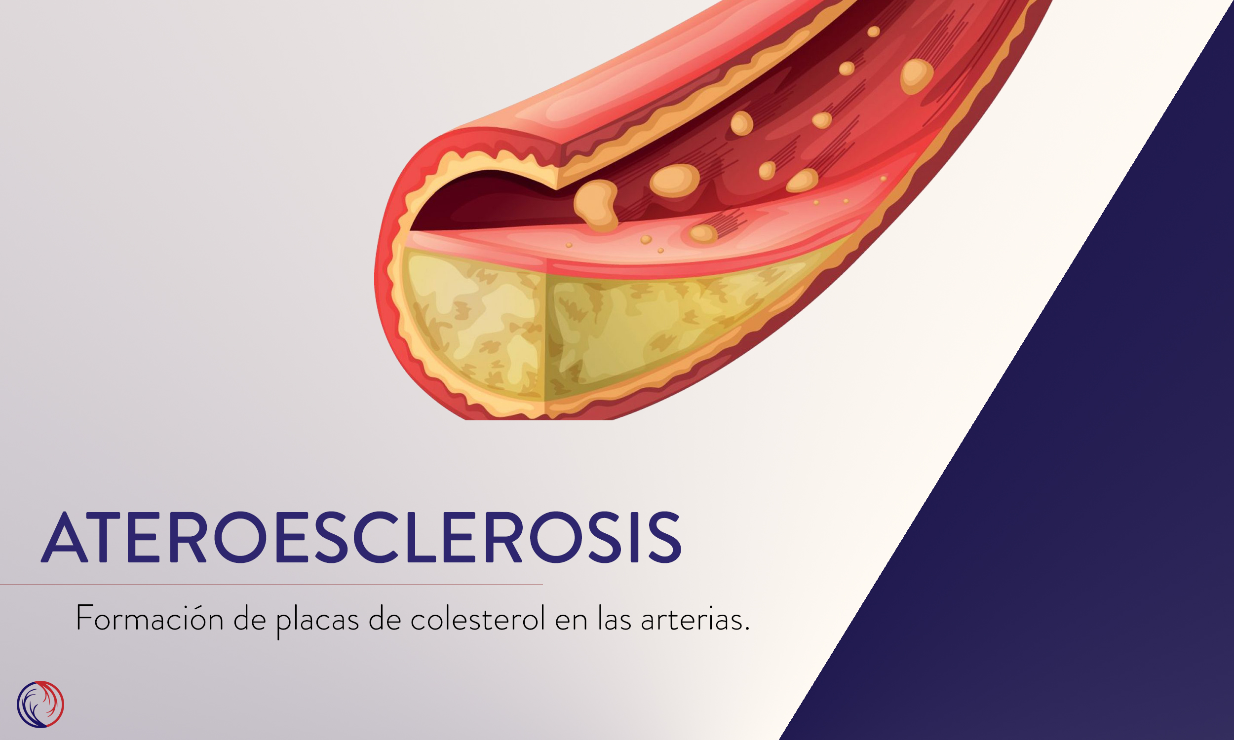 Ateroesclerosis