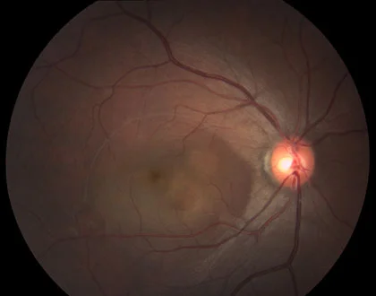 central-serous-choroidopathy_4202.jpg