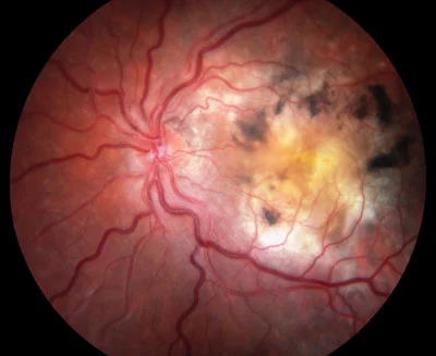 macular-degeneration-wet_400.jpg