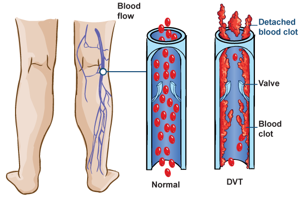 thrombosis_lg.png