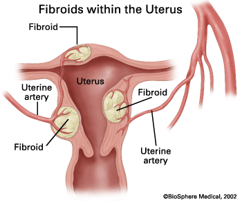 uterine-fibroids-2.gif