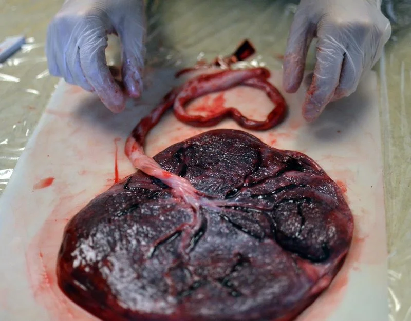 Placenta examination by person with gloved hands