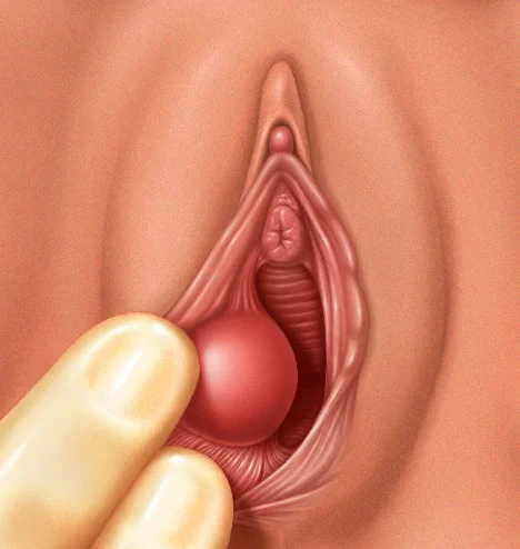 Bartholins-cyst.jpg