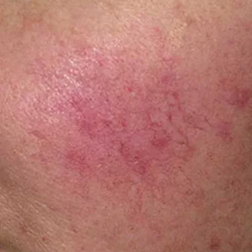 Rosacea-web.jpg