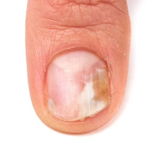Onychomycosis