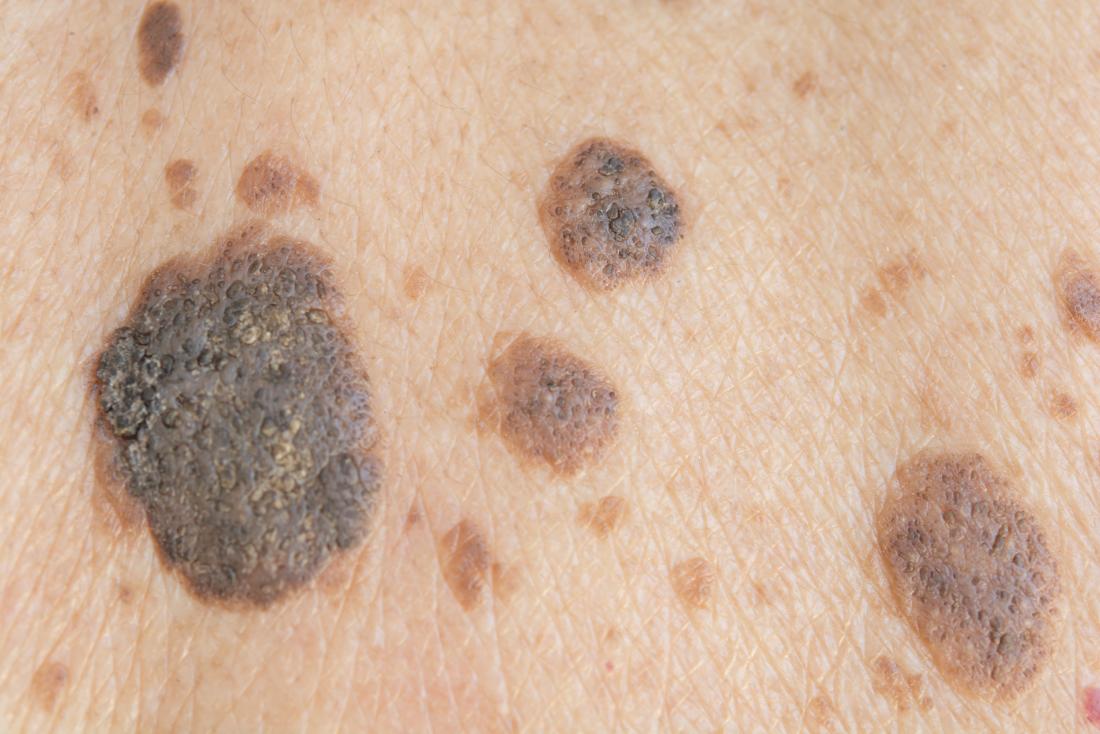 Seborrhoeic Keratosis