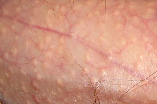 Fordyces_spot_closeup-web.jpg
