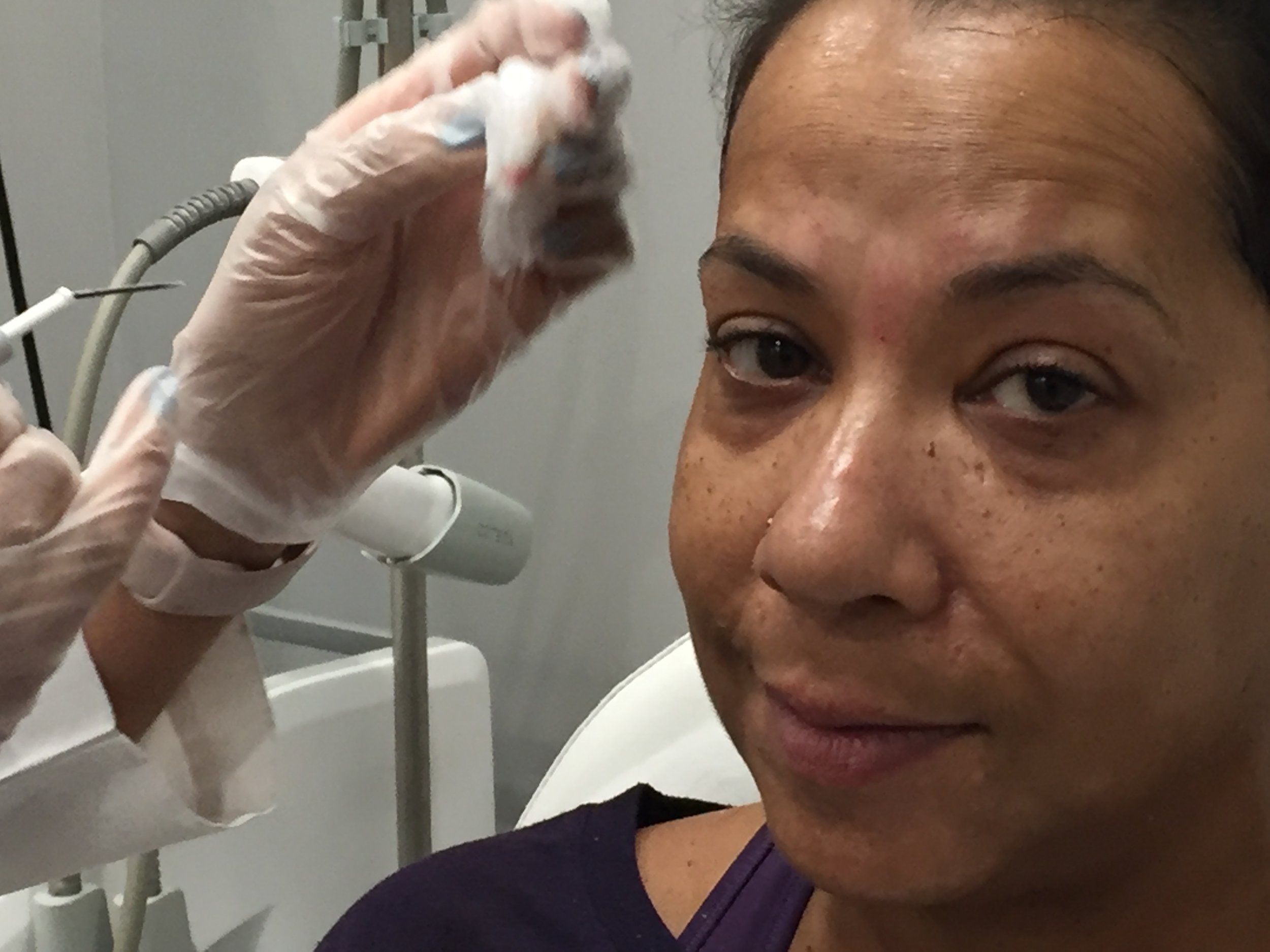 The Infamous Face Mole