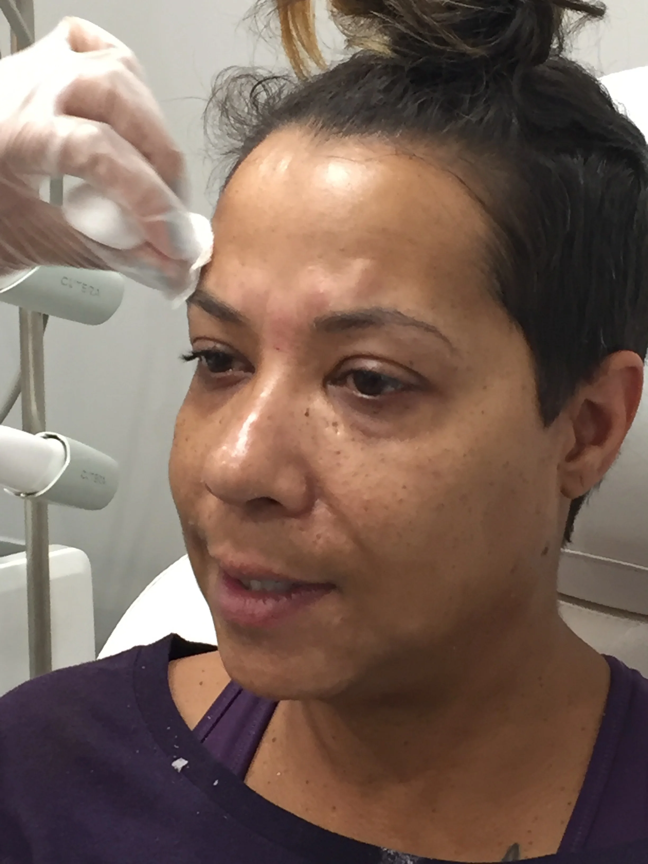 To Botox or Nox (Not)