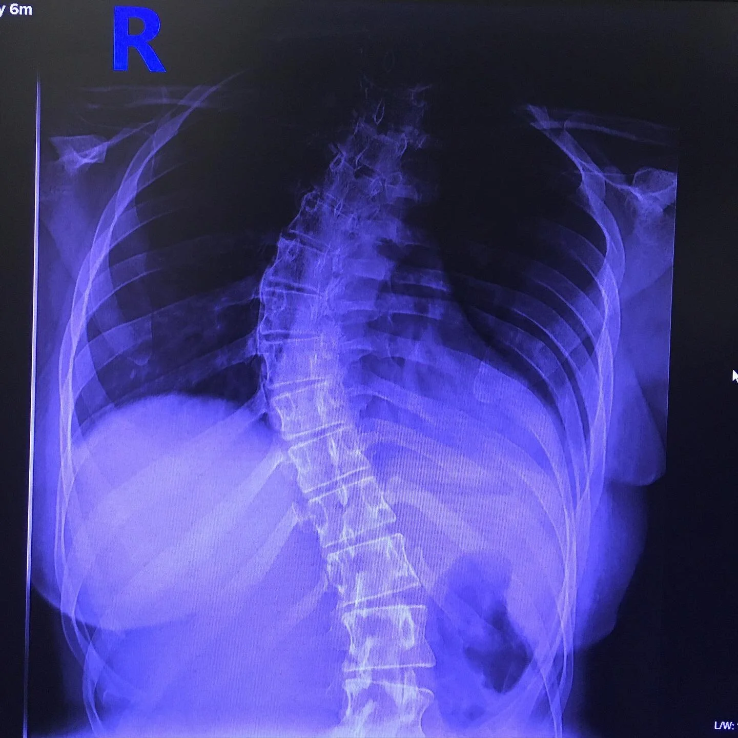 Scoliosis update 🤙