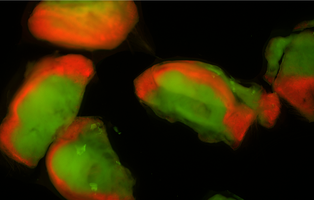 Tumor slices.png