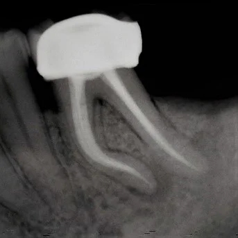 Examples of our work at Norfolk Endodontics