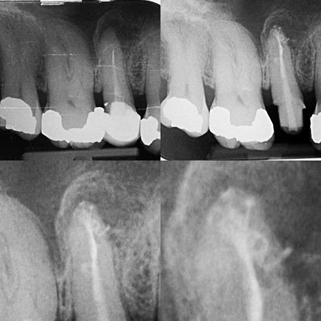 Re-rct, fibre post and core...
Root canal filling or 3d obturation?
#rootcanal #apicaldelta #warmverticalcondesation #specialistendodontics