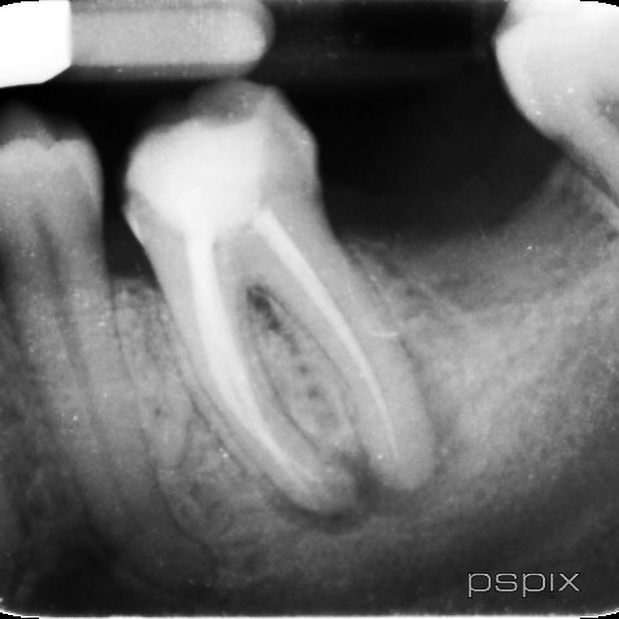 Non-surgical retreatment of lower first molar with sexy lateral canal!
#warmverticalcondesation #specialistendodontics #3dobturation #saveatooth #lateralcanal #rootcanal