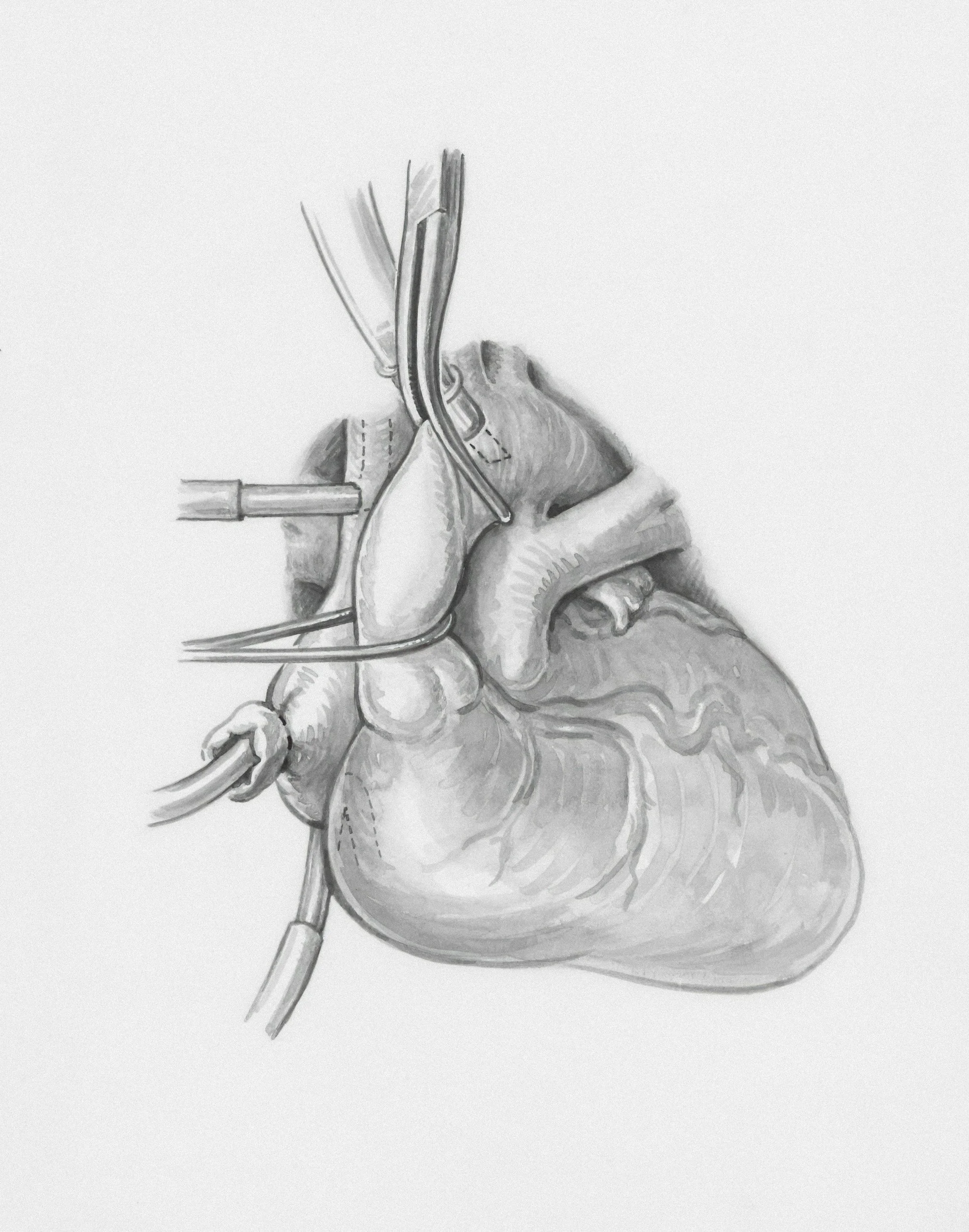 Optimize Cardiac Rhythm Management With Modeling and Simulation