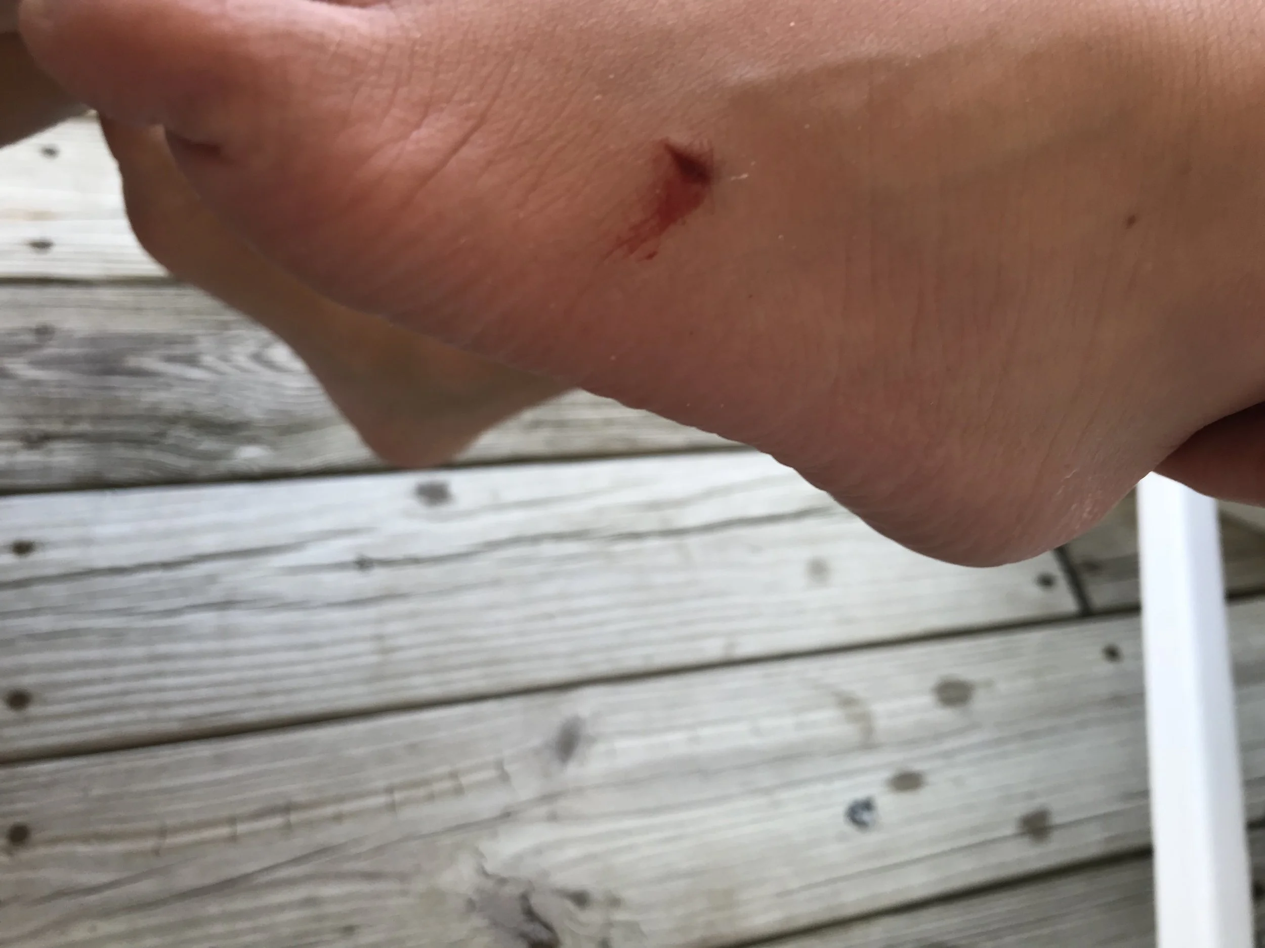 Stingray sting... ouch! 