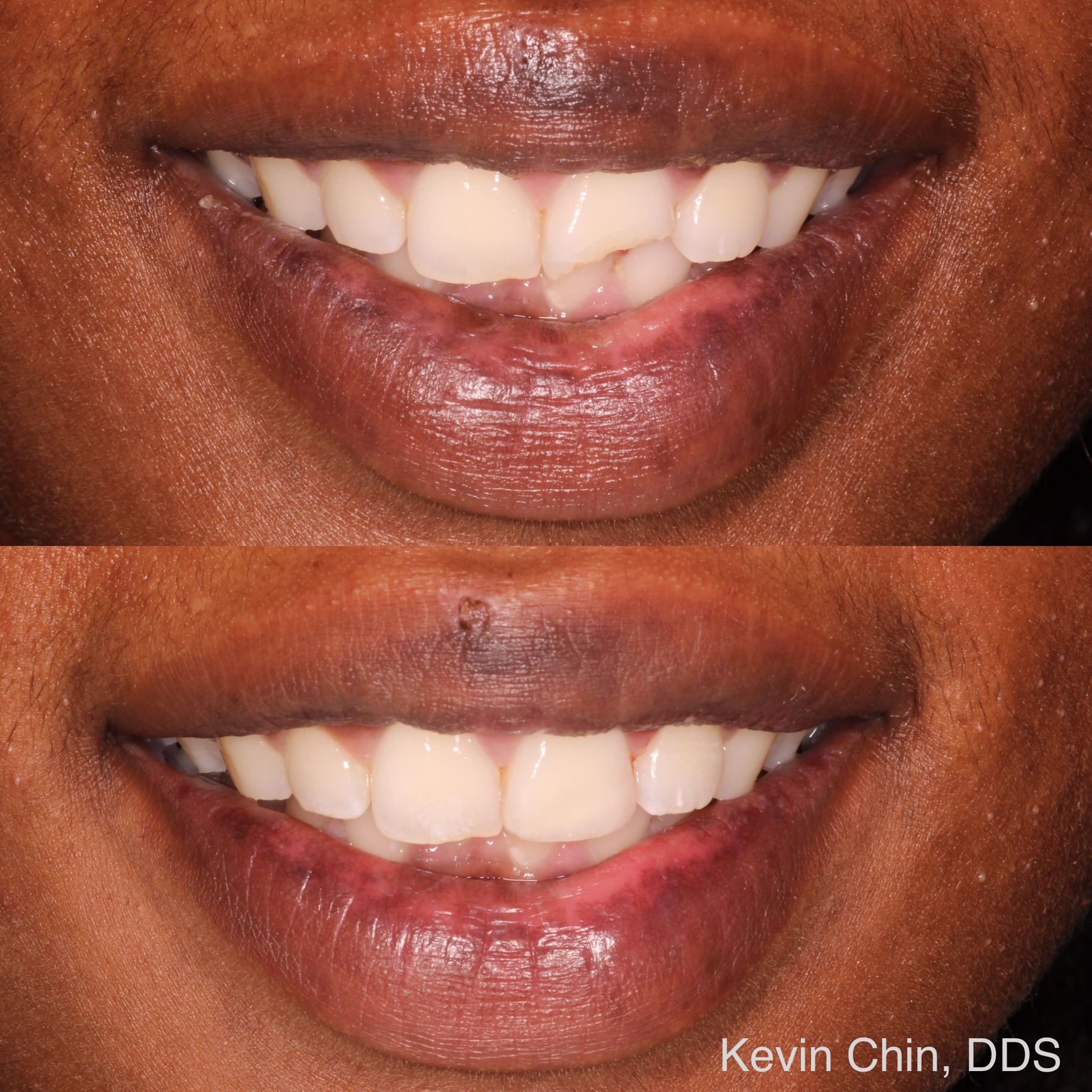 Composite Bonding for a chipped tooth