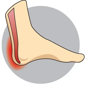 Achilles Tendonitis