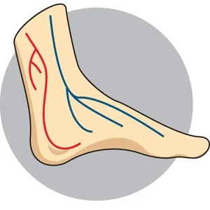 Diabetic Foot