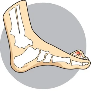 Hammer Toe
