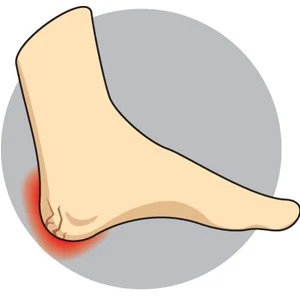 Heel Fissures