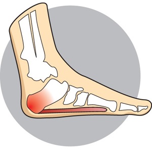 Heel Pain