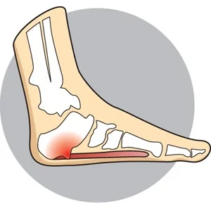 Heel Spurs