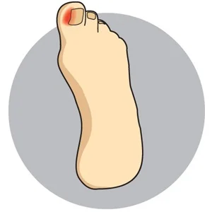 Ingrown Toe Nails