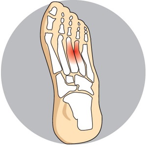 Morton's Neuroma