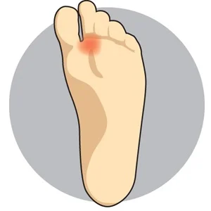 Morton's Toe