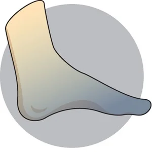 Diabetic Neuropathy
